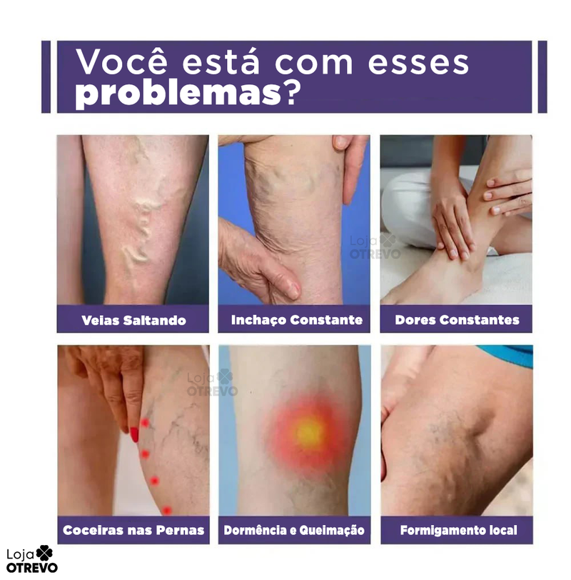 Creme Removedor Rápido de Varizes - Varimax® (ELIMINAÇÃO TOTAL DAS VARIZES)