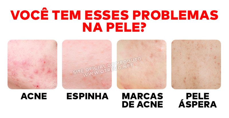 Sérum Removedor de Acne e Poros Dilatados - AcneLanbéna®