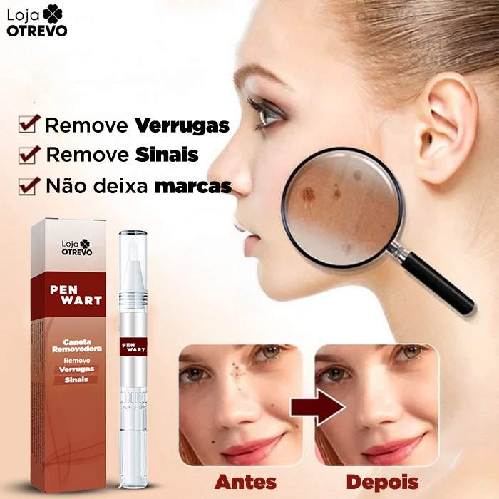 PenWart® - Caneta Removedora de Verrugas e Sinais da Pele (EFEITO IMEDIATO)