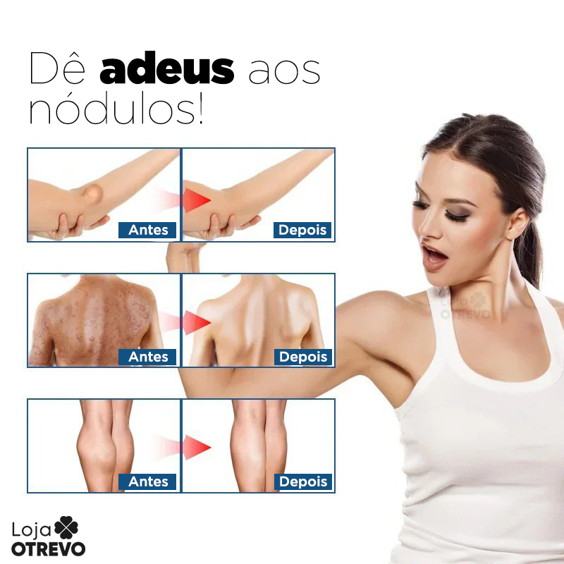 Spray Removedor de Nódulos - Lipomax®