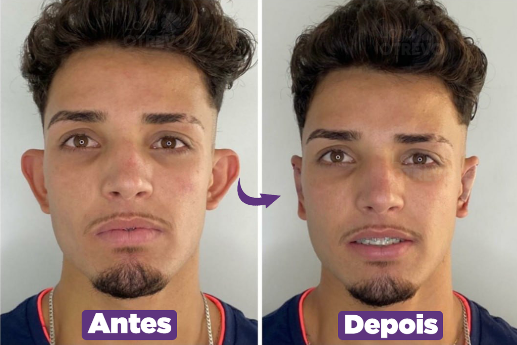 Adesivos Reutilizaveis Corretores de Orelha - EarIt®