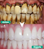 Spray Restaurador Rápido de Dentes - Própolis Oral