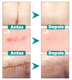 Spray Removedor Rápido de Cicatriz - ScarMax®