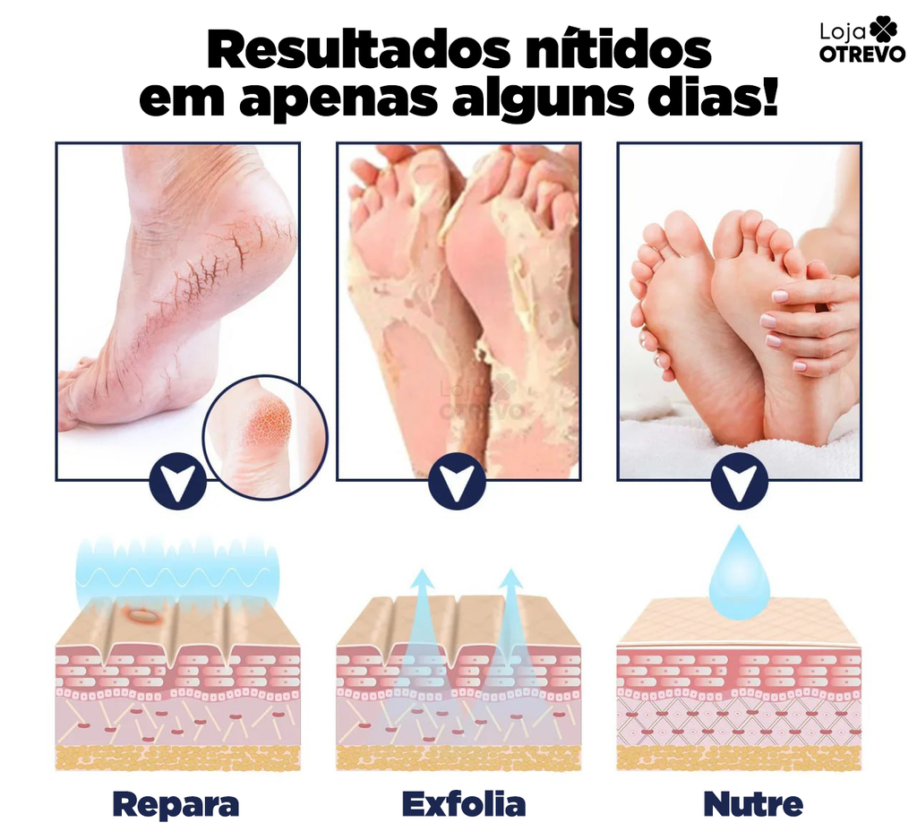 Bastão Removedor de Calos e Rachaduras (SUPER HIDRATANTE) BabyFeet®