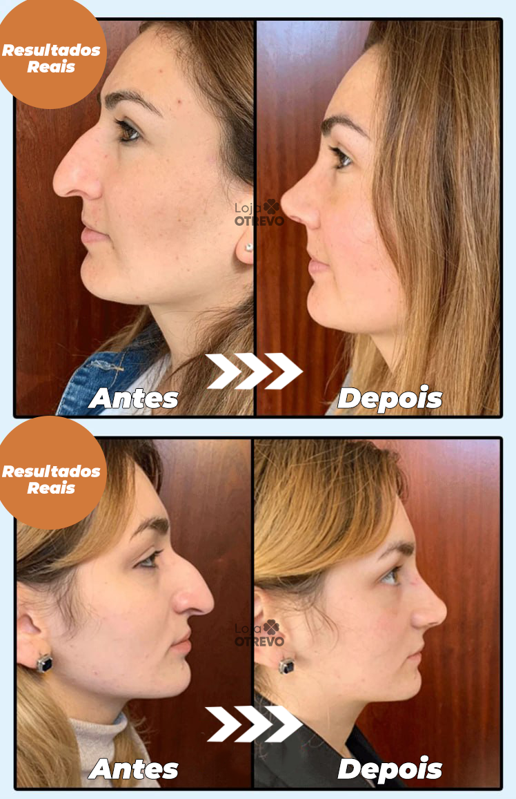 Sérum Definidor e Modelador de Nariz - DefRino®