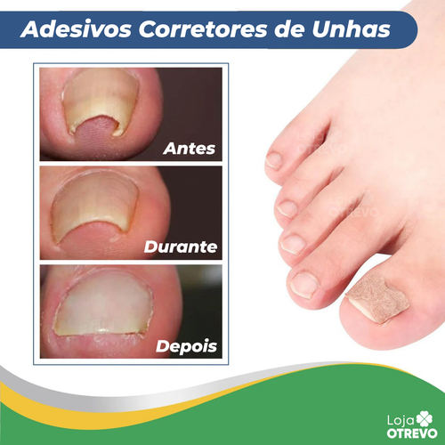 Adesivos Corretores de Unha - PatchNail® (REPARAÇÃO EM 7 DIAS)