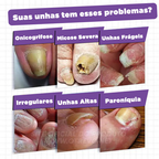 Spray Reparador de Unhas 3 em 1 (Reparador, Restaurador e Fortalecedor de Unhas) MedNail®