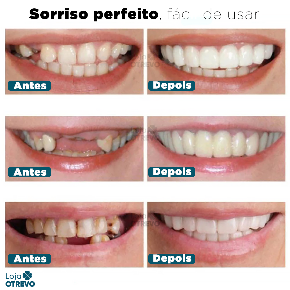  Facetas Dentárias Naturais Removíveis
