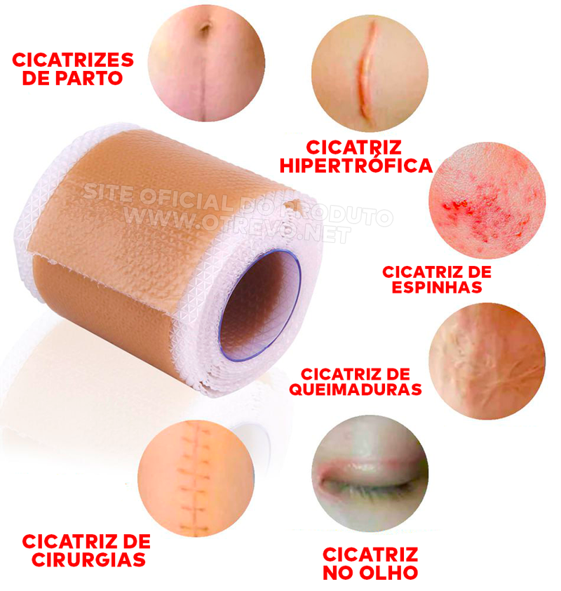 Fita de Silicone Gel Clareador Para Cicatriz (3 METROS)  - ®SilconeScar