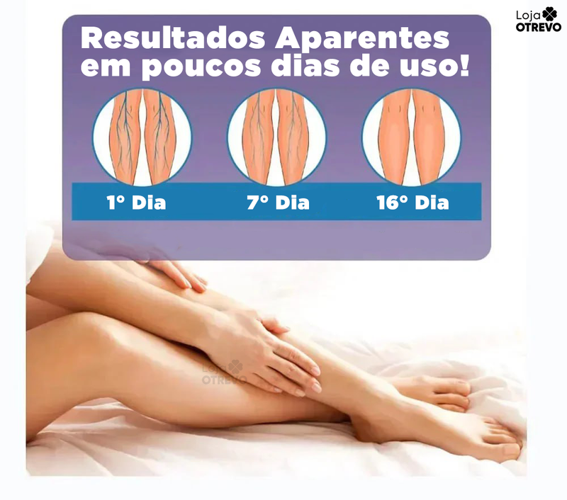 Creme Removedor Rápido de Varizes - Varimax® (ELIMINAÇÃO TOTAL DAS VARIZES)