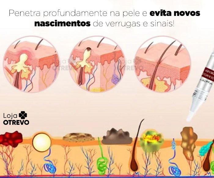 PenWart® - Caneta Removedora de Verrugas e Sinais da Pele (EFEITO IMEDIATO)