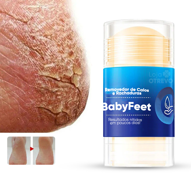 Bastão Removedor de Calos e Rachaduras (SUPER HIDRATANTE) BabyFeet®