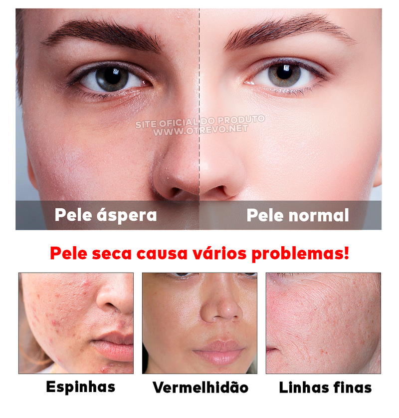 Sérum Removedor de Acne e Poros Dilatados - AcneLanbéna®