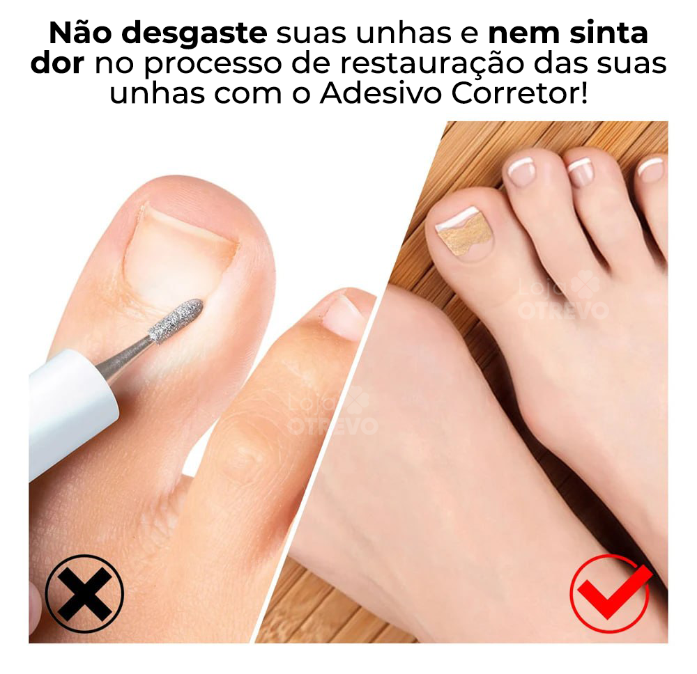 Adesivos Corretores de Unha - PatchNail® (REPARAÇÃO EM 7 DIAS)