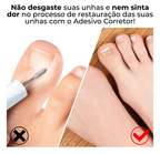 Adesivos Corretores de Unha - PatchNail® (REPARAÇÃO EM 7 DIAS)