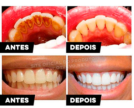 Clareador Dental - ®V34 (Clareamento instantâneo)