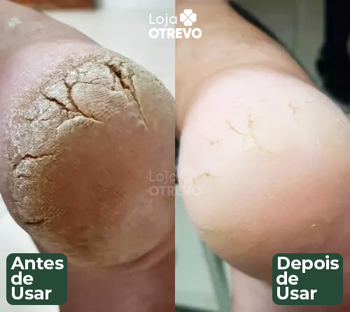 DermaShield - Spray Restaurador Rápido de Pés
