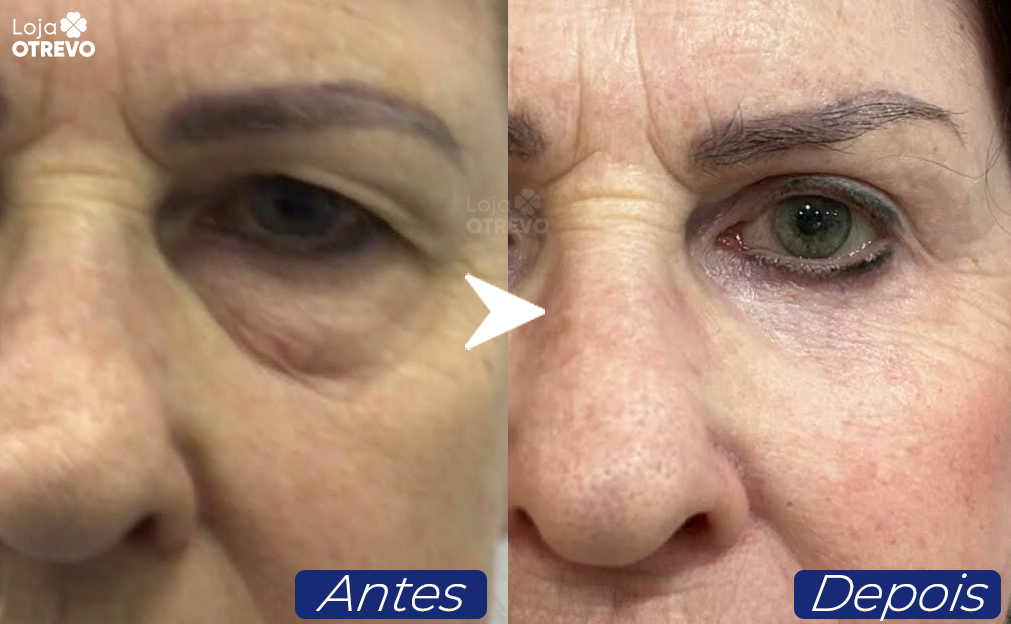 Creme Reparador de Olhos Caidos - LifitEye®