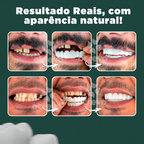 Nature Smile® - Facetas Dentárias Removíveis (COMPRE 1 PAR E LEVE OUTRO)