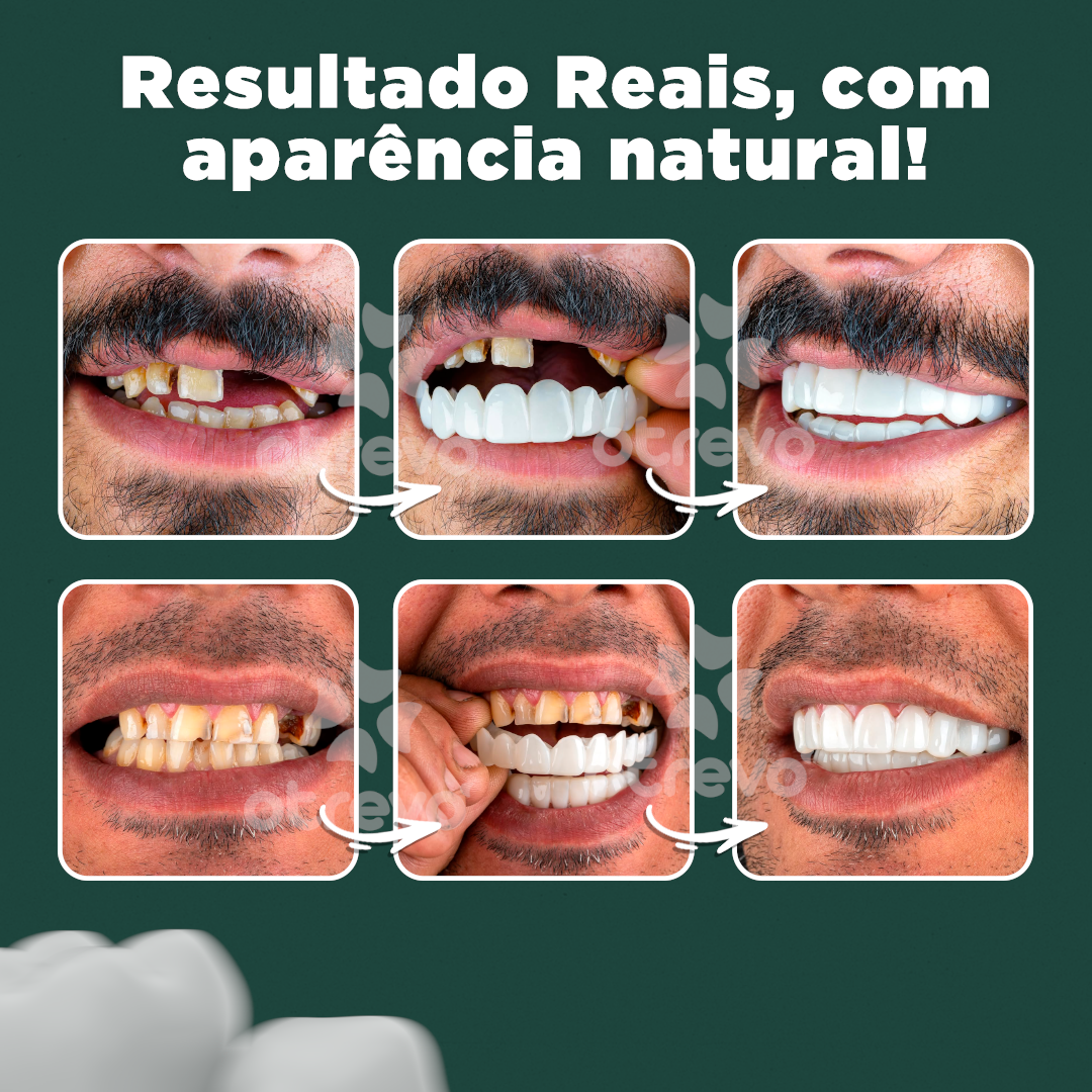 Nature Smile® - Facetas Dentárias Removíveis (COMPRE 1 PAR E LEVE OUTRO)