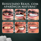 (Nature Smile) - Facetas Dentárias Removíveis