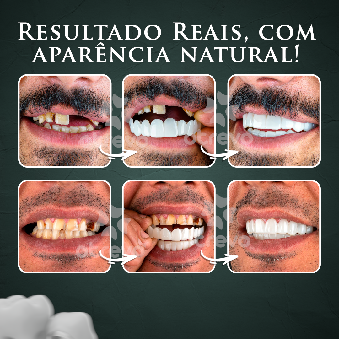 (Nature Smile) - Facetas Dentárias Removíveis