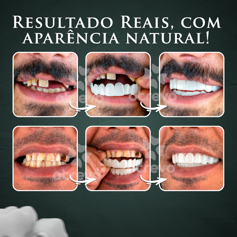Nature Smile® - Facetas Dentárias Removíveis (COMPRE 1 PAR E LEVE OUTRO)