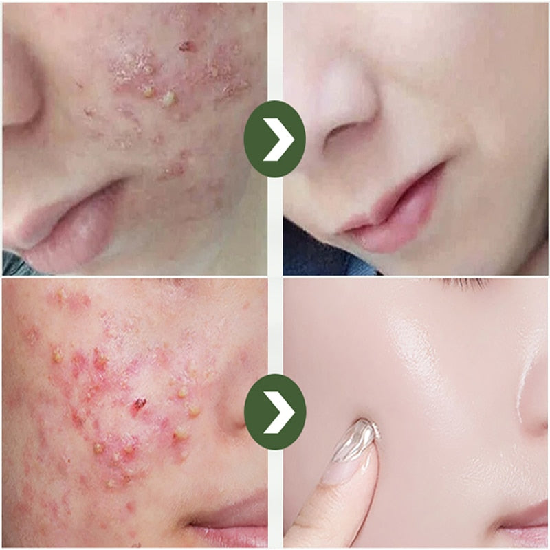 Sérum Removedor de Acne e Poros Dilatados - AcneLanbéna®