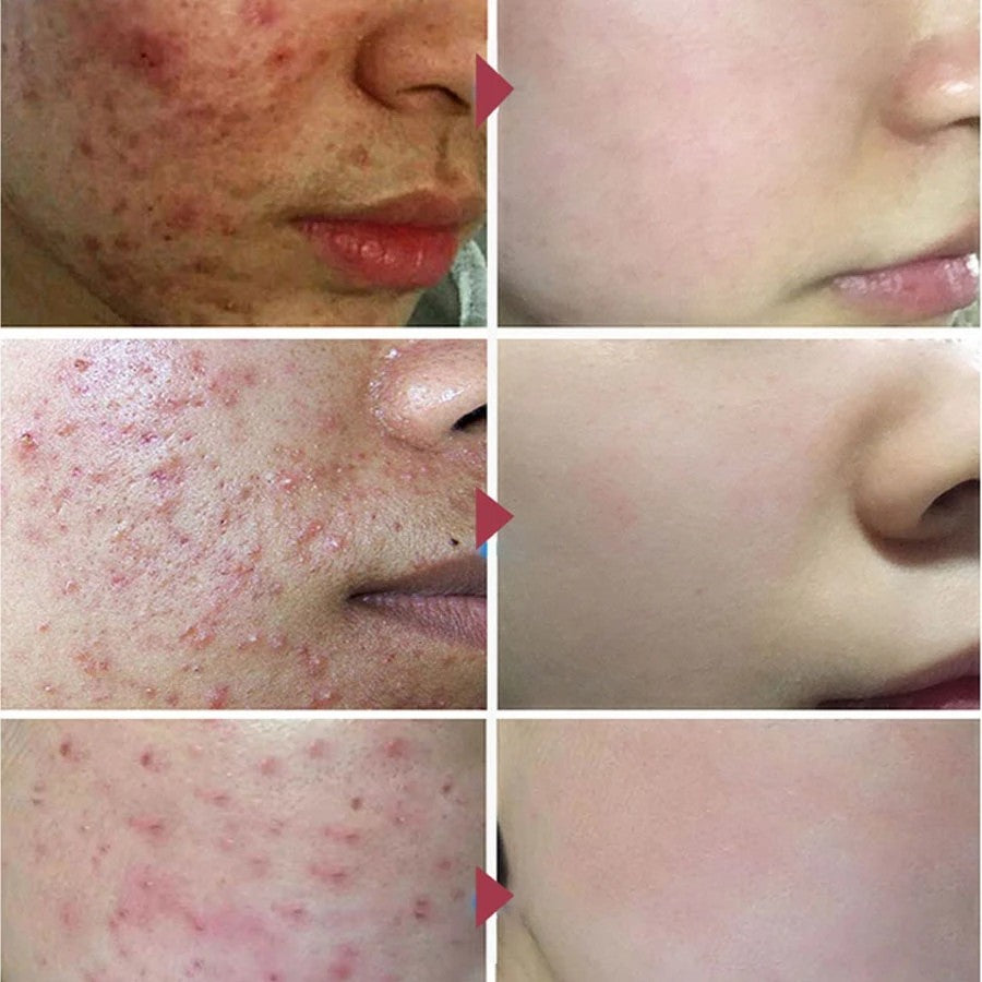 Sérum Removedor de Acne e Poros Dilatados - AcneLanbéna®