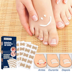 Adesivos Corretores de Unha - PatchNail® (REPARAÇÃO EM 7 DIAS)