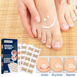 Adesivos Corretores de Unha - PatchNail® (REPARAÇÃO EM 7 DIAS)