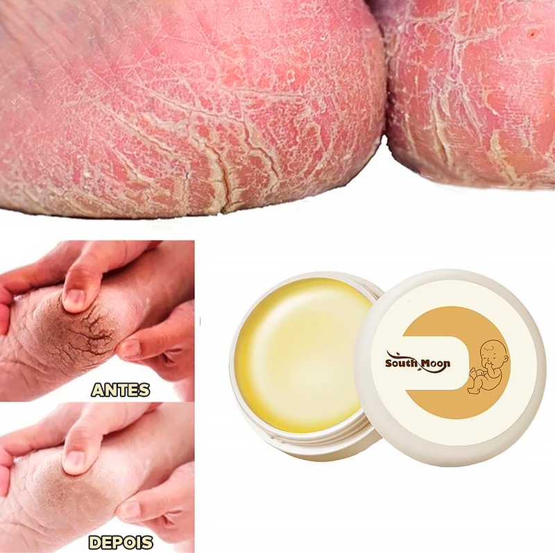 Cera Removedora de Calos e Rachaduras - ®Foot Gold