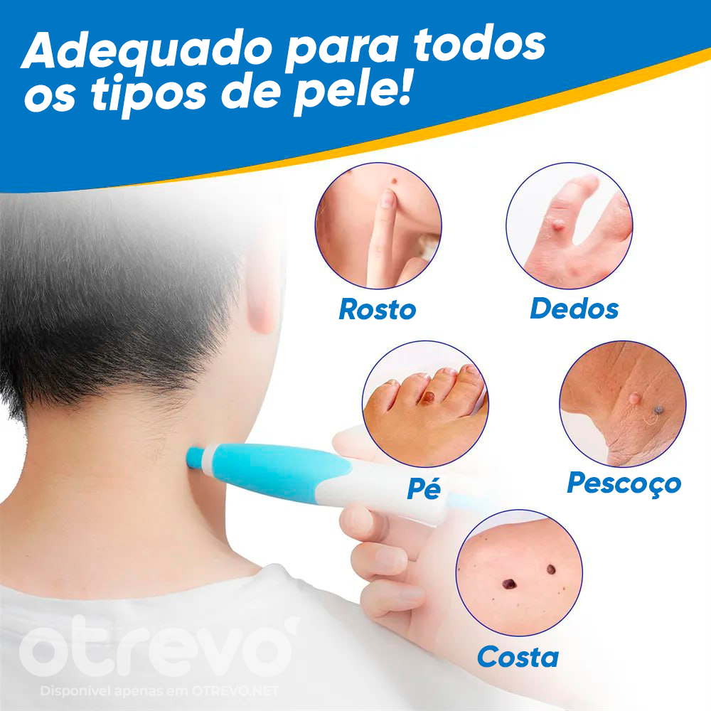 Removedor de Verrugas e Sinais da Pele