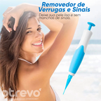 Removedor de Verrugas e Sinais da Pele