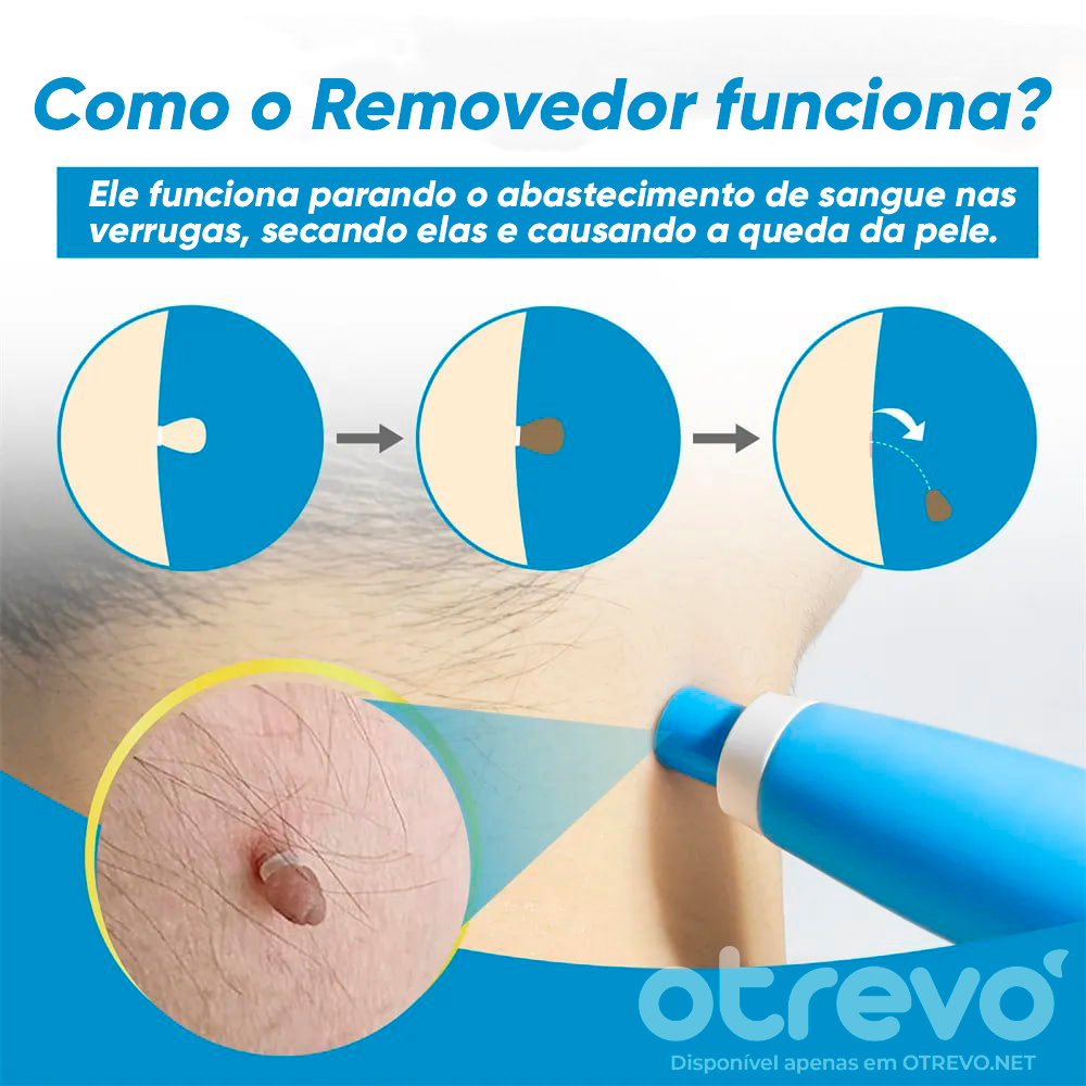 Removedor de Verrugas e Sinais da Pele