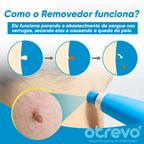 Removedor de Verrugas e Sinais da Pele