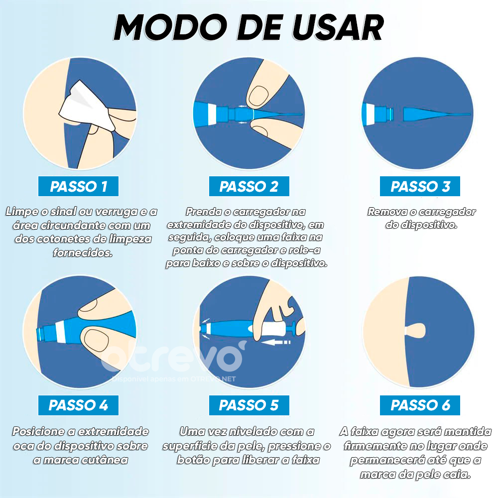 Removedor de Verrugas e Sinais da Pele