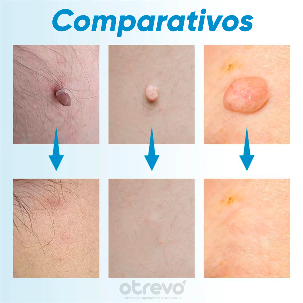 Removedor de Verrugas e Sinais da Pele