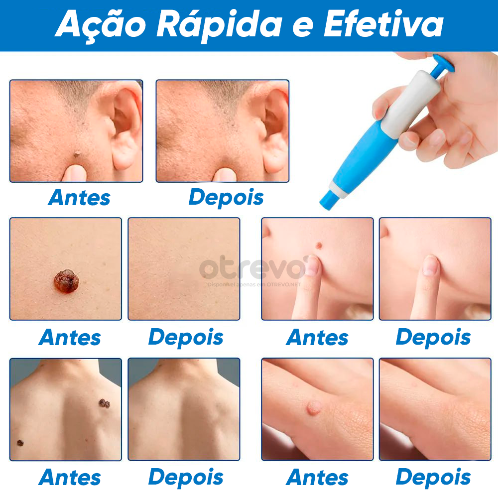 Removedor de Verrugas e Sinais da Pele