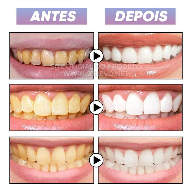 Gloss Clareador Dental Instântaneo - SMILEKIT®