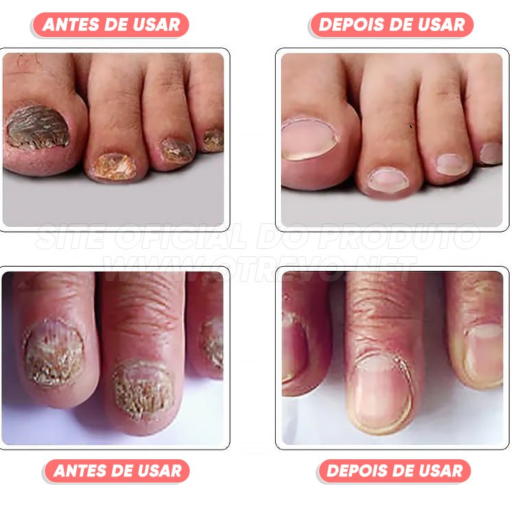 FungiPró RtopR® 3 em 1 (Reparador, Restaurador e Fortalecedor de Unhas)