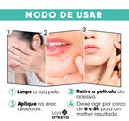 Adesivos Hidrocoloide Secadores e Removedores de Espinhas - AcneControl®