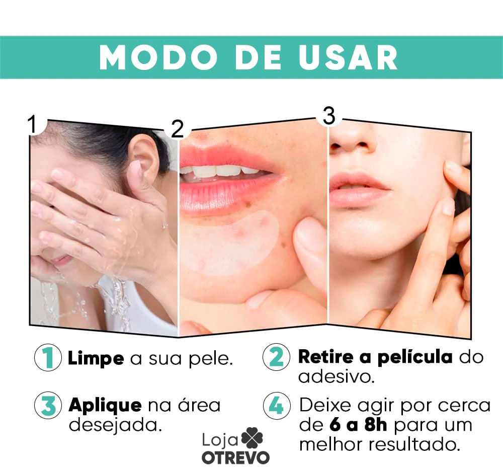 Adesivos Hidrocoloide Secadores e Removedores de Espinhas - AcneControl®