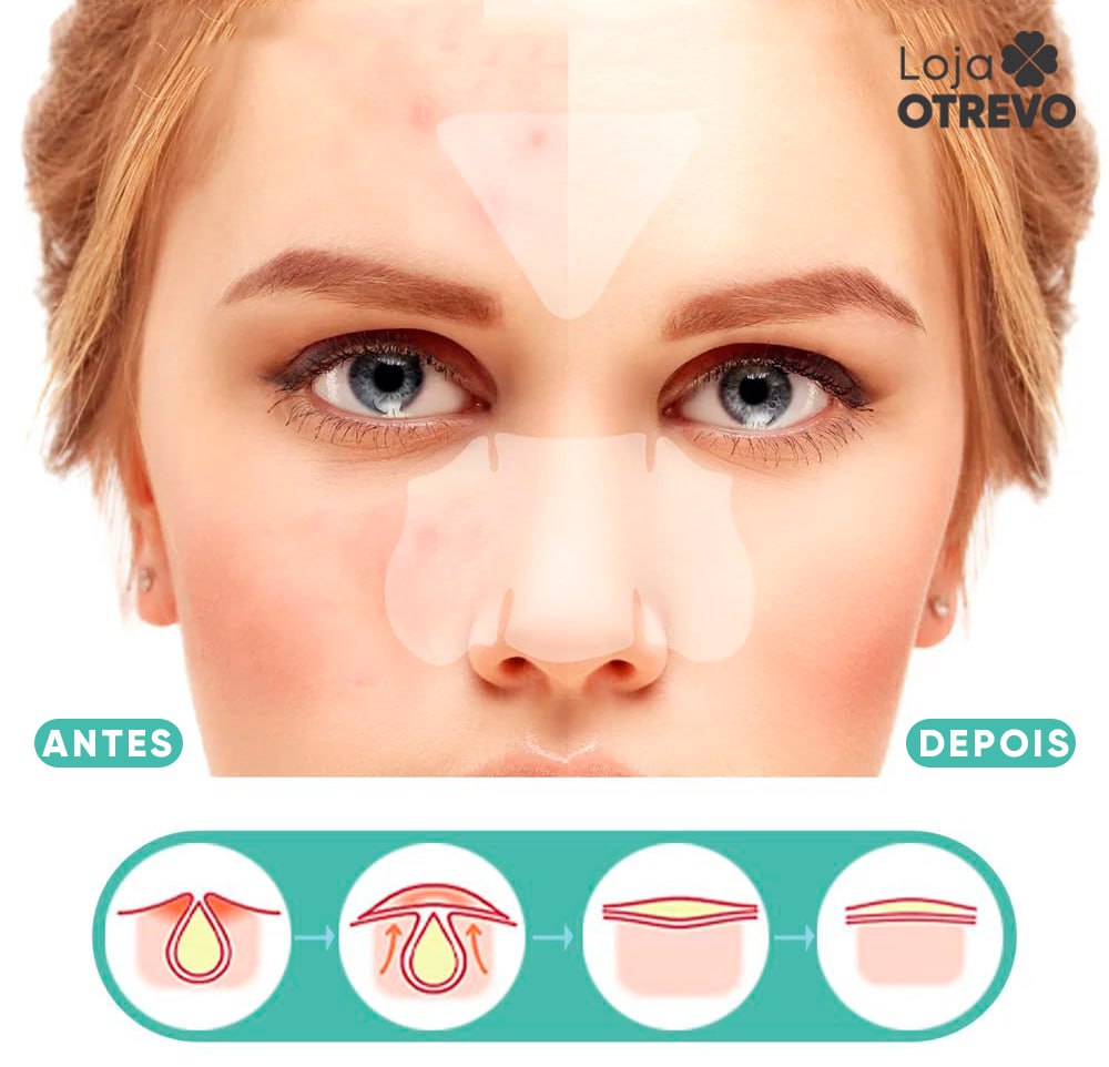 Adesivos Hidrocoloide Secadores e Removedores de Espinhas - AcneControl®