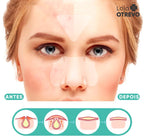 Adesivos Hidrocoloide Secadores e Removedores de Espinhas - AcneControl®