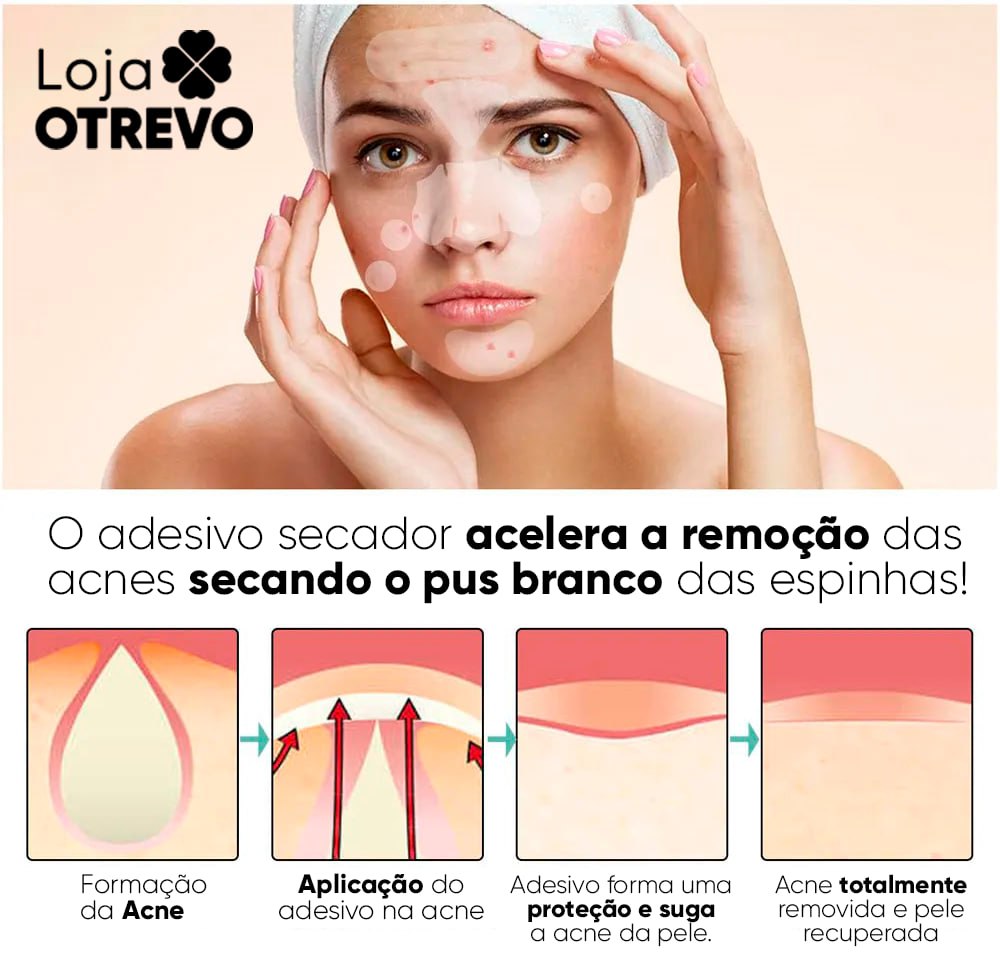 Adesivos Hidrocoloide Secadores e Removedores de Espinhas - AcneControl®