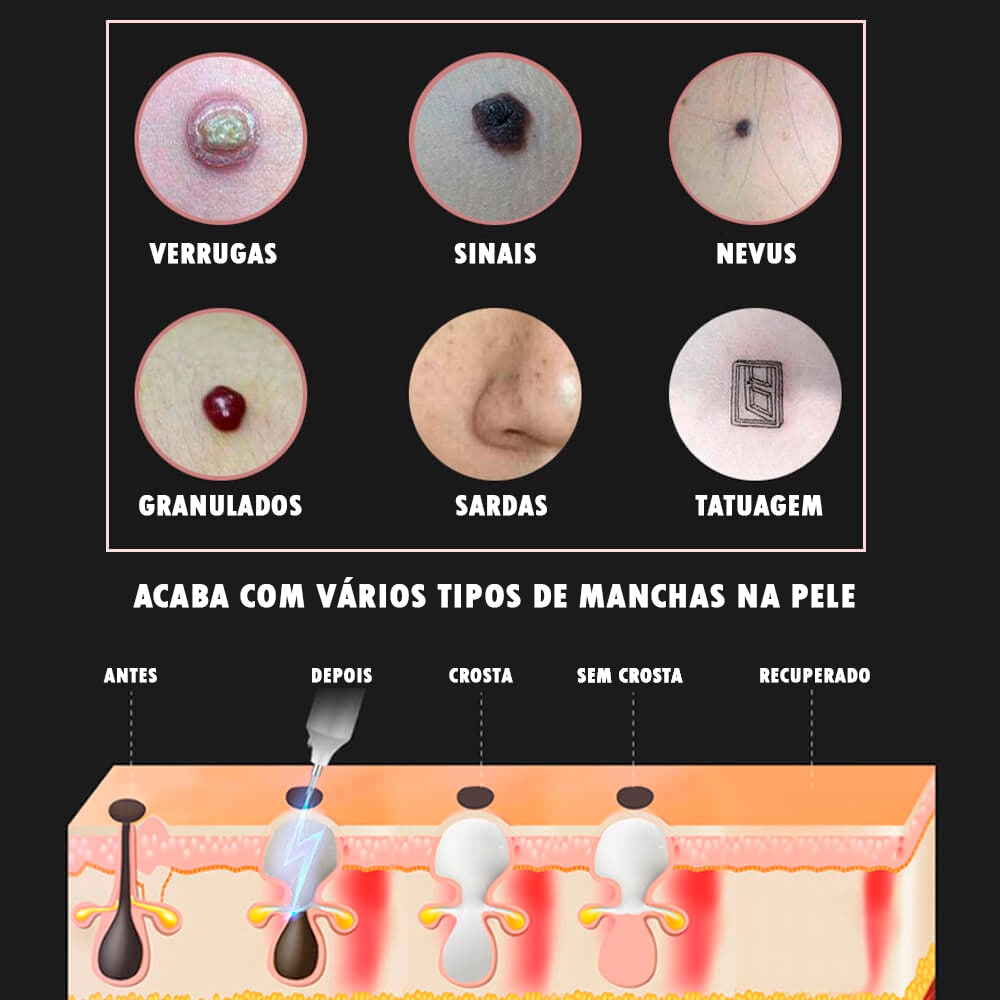 Caneta Laser Plasma 9 em 1 Removedora de manchas, verrugas, sardas e tatuagem ®PenPlasma