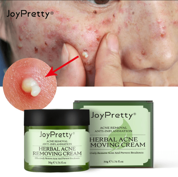 Creme Removedor de Espinha - ®JoyPretty  (Rejuvenesce e remove as imperfeições)