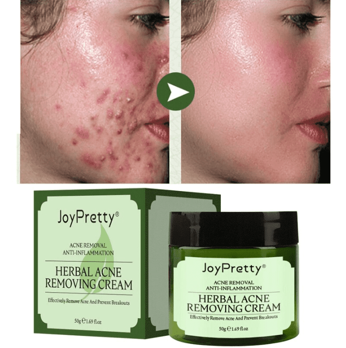 Creme Removedor de Espinha - ®JoyPretty  (Rejuvenesce e remove as imperfeições)