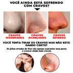 Removedor de Cravos a Base de Bambu - SkinBamboo® (REMOÇÃO 100% DOS CRAVOS)